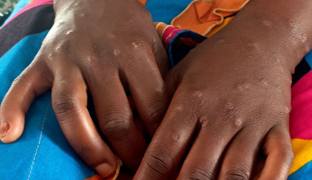 Mpox