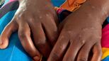 Mpox