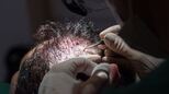 Haartransplantation nach der FUT-Methode bei einer Patientin