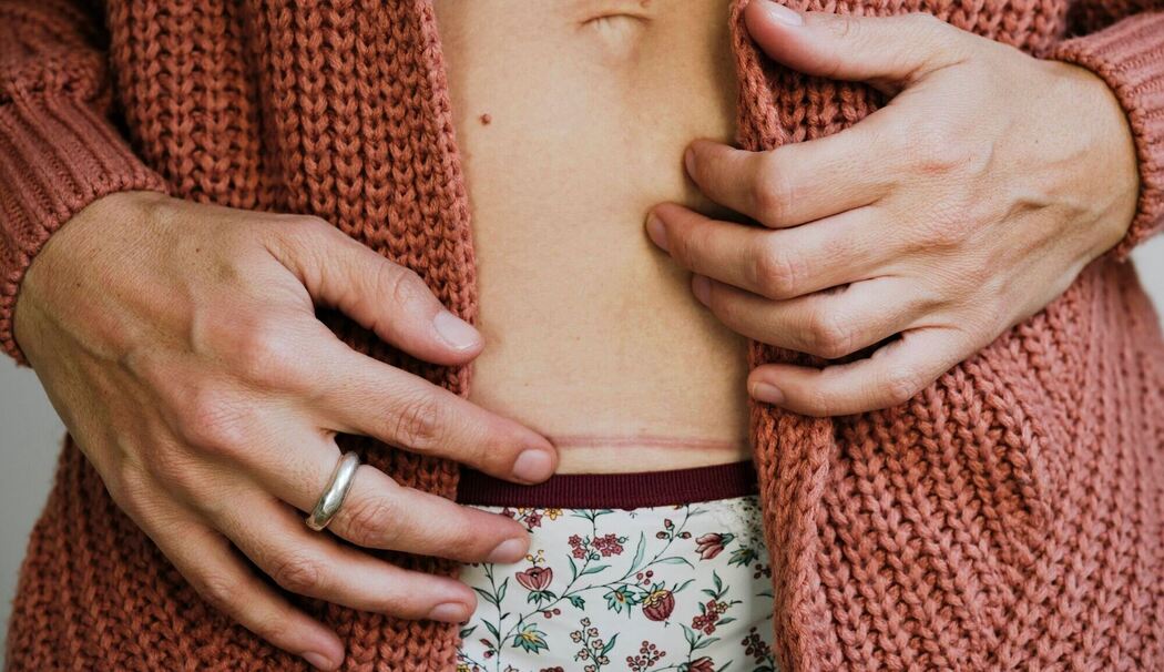 Eine Frau berührt ihre Kaiserschnittnarbe Eine Frau berührt ihre Kaiserschnittnarbe