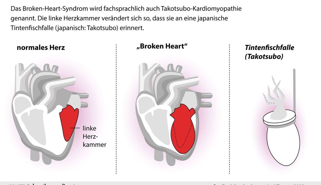 Broken-Heart-Syndrom