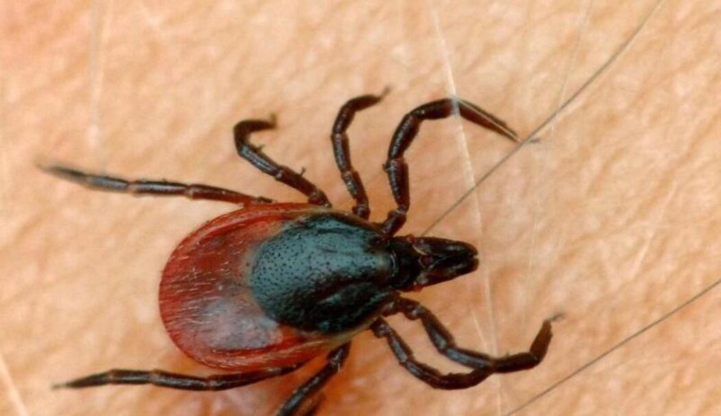 Zeckenbiss: Symptome für FSME und Borreliose Zeckenbiss: Symptome für FSME und Borreliose